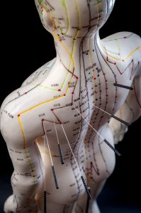 Acupuncture needles inserted on a mannequin's back for therapeutic purposes.